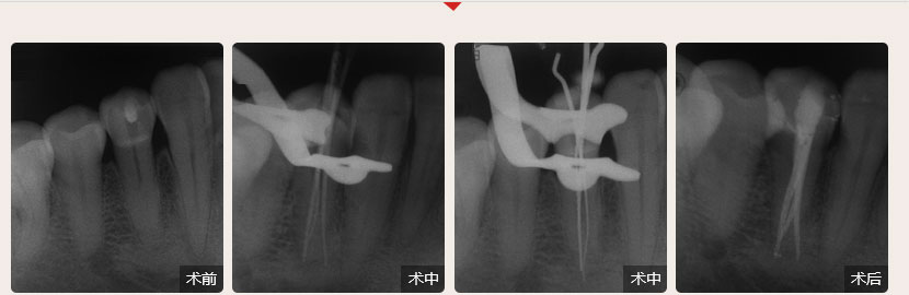 順德德倫口腔醫(yī)生全國(guó)根管治療技術(shù)競(jìng)賽案例