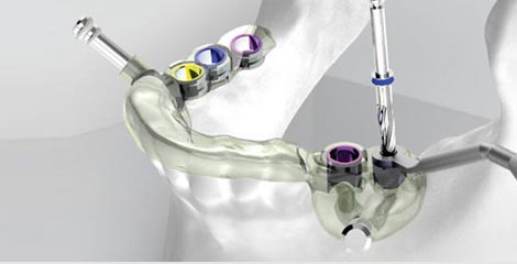 數(shù)字化種植牙